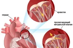 Лікування пролапса мітрального клапана (мітрального) Лікування пролапса мітрального клапана