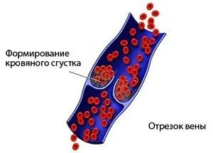 Лікування судин лазером тромбофлебіт, тромбоз, атеросклероз (тромбоз) Лікування судин лазером тромбофлебіт, тромбоз, атеросклероз