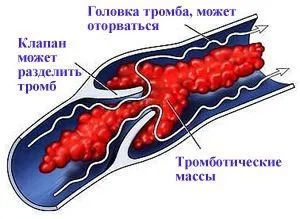 Лікування судин лазером тромбофлебіт, тромбоз, атеросклероз (атеросклероз) Лікування судин лазером тромбофлебіт, тромбоз, атеросклероз