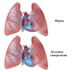 Легенева регургітація 1 ступеня-що це таке (ступеня) Легенева регургітація 1 ступеня-що це таке