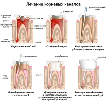 Лікування каналів зуба етапи, ціна в Москві (лікування) Лікування каналів зуба етапи, ціна в москві