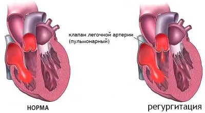 Легенева регургітація 1 ступеня-що це таке (порушення функцій клапана) Легенева регургітація 1 ступеня-що це таке