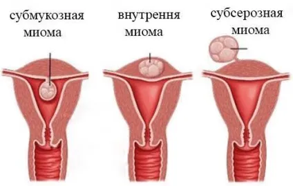 Лікування міоми ефективними народними засобами, рецепти які допомогли (травами) Лікування міоми ефективними народними засобами, рецепти які допомогли