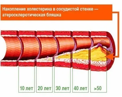 Лікування судин лазером тромбофлебіт, тромбоз, атеросклероз
