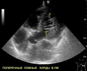 Хибна хорда лівого шлуночка причини утворення (помилкова) Хибна хорда лівого шлуночка причини утворення