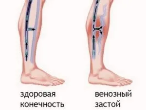 Венозний застій судин головного мозку, в малому тазу, в ногах і в легких (застій) Венозний застій судин головного мозку, в малому тазу, в ногах і в легких