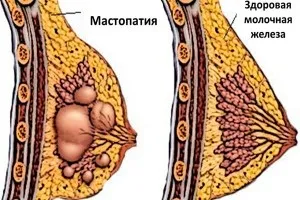 Мастопатія що з цим робити (наявності злоякісних клітин) Мастопатія що з цим робити