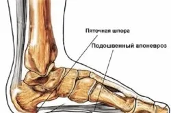 Мазь для лікування п'яткової шпори (здорові стопи) Мазь для лікування п'яткової шпори