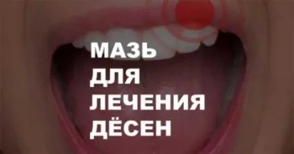 Мазь для ясен найбільш ефективні лікарські препарати (найбільш) Мазь для ясен найбільш ефективні лікарські препарати