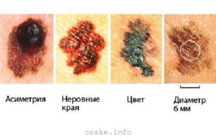 Меланома симптоми і як розпізнати фото (рак шкіри) Меланома симптоми і як розпізнати фото