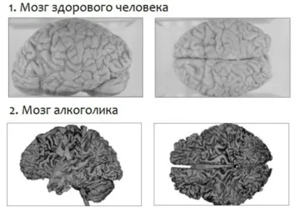 Мозок і алкоголь вплив і відновлення мозку після алкоголю (після) Мозок і алкоголь вплив і відновлення мозку після алкоголю