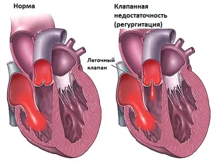 Недостатність клапана легеневої артерії - фактори ризику, причини, симптоми регургітації легеневого (недостатність) Недостатність клапана легеневої артерії - фактори ризику, причини, симптоми регургітації легеневого