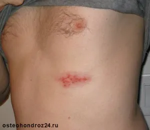 Вітрянка у дорослих симптоми і лікування (набряк головного мозку) Вітрянка у дорослих симптоми і лікування