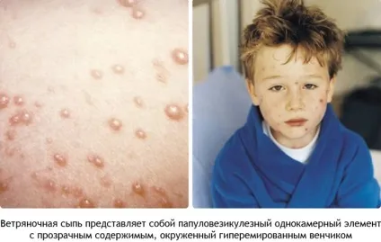 Вітрянка як передається і як лікувати народними засобами (народними) Вітрянка як передається і як лікувати народними засобами