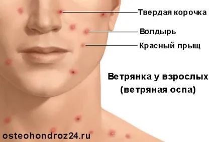 Вітрянка у дорослих симптоми і лікування (симптоми) Вітрянка у дорослих симптоми і лікування