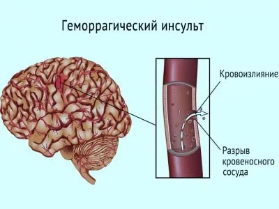 Обширний крововилив в мозок з інсультом наслідки, причини та лікування (наслідки) Обширний крововилив в мозок з інсультом наслідки, причини та лікування