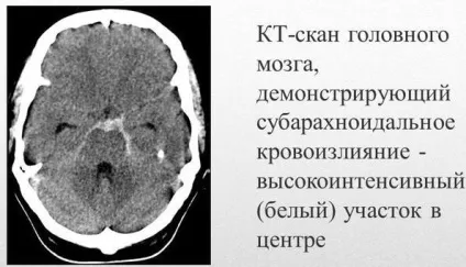 Обширний крововилив в мозок, шлуночки, стовбур, оболонки (шлуночки) Обширний крововилив в мозок, шлуночки, стовбур, оболонки