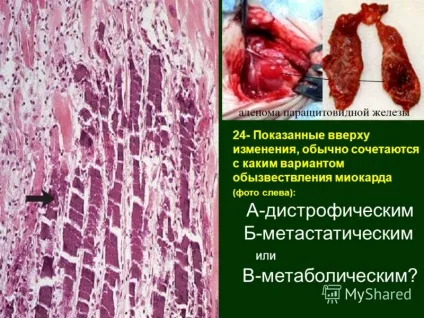 Звапніння, що це таке кальциноз аорти, клапанів серця і судин, я, ти і всі навколо