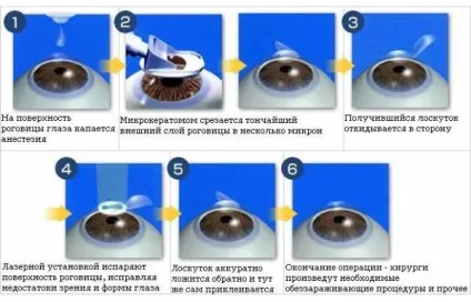 Обмеження після лазерної корекції зору і ускладнення (корекції) Обмеження після лазерної корекції зору і ускладнення