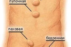 Пухлина в паху у чоловіків причини і діагностика (причини) Пухлина в паху у чоловіків причини і діагностика