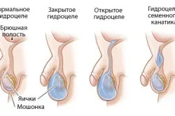 Пухлина в паху у чоловіків причини і діагностика (чоловіків) Пухлина в паху у чоловіків причини і діагностика