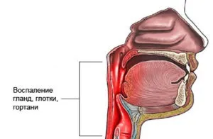 Гострий тонзилофарингіт симптоми і лікування (фото) (гострий) Гострий тонзилофарингіт симптоми і лікування (фото)