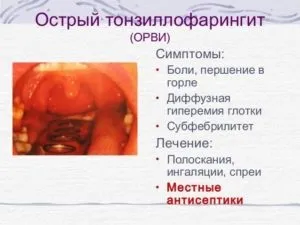 Гострий тонзилофарингіт симптоми і лікування (фото) (тонзилофарингіт) Гострий тонзилофарингіт симптоми і лікування (фото)