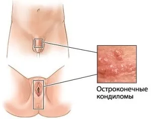 гострі кондиломи