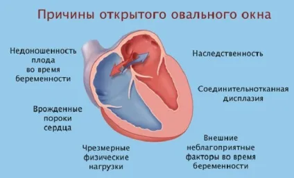 Відкрите овальне вікно у дітей - причини, симптоми і лікування