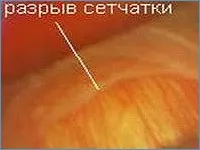 Відшарування сітківки ока