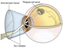 Відшарування сітківки ока види операцій (сітківки) Відшарування сітківки ока види операцій