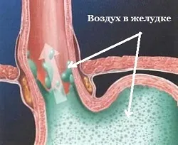 Відрижка повітрям (натще і після їжі) причини, лікування (після) Відрижка повітрям (натще і після їжі) причини, лікування