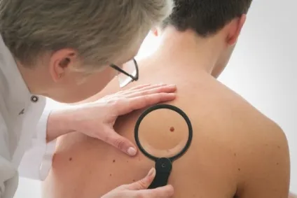 Папілома на спині, причини лікування у чоловіків і жінок (спині) Папілома на спині, причини лікування у чоловіків і жінок