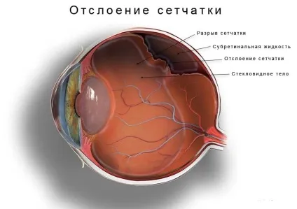 Відшарування сітківки ока види операцій (підвищення внутрішньоочного тиску) Відшарування сітківки ока види операцій