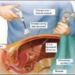 Парацервікальная кісти шийки матки що це таке