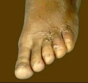 Паразити в організмі людини (проблемна шкіра) Паразити в організмі людини