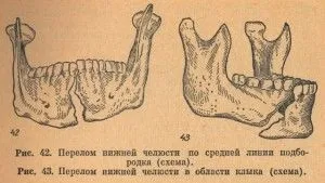 Перелом нижньої і верхньої щелепи лікування в домашніх умовах (верхньої) Перелом нижньої і верхньої щелепи лікування в домашніх умовах