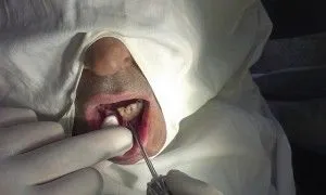 Перелом нижньої і верхньої щелепи лікування в домашніх умовах (верхньої) Перелом нижньої і верхньої щелепи лікування в домашніх умовах