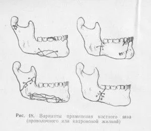Перелом нижньої і верхньої щелепи лікування в домашніх умовах (перелом) Перелом нижньої і верхньої щелепи лікування в домашніх умовах