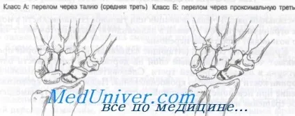 Перелом човноподібної кістки (лікування перелому човноподібної кістки) Перелом човноподібної кістки