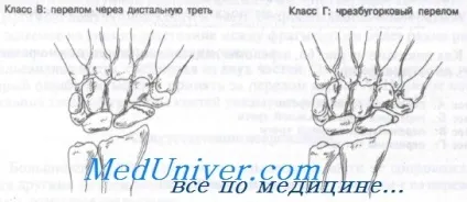 Перелом човноподібної кістки (ладьевидной) Перелом човноподібної кістки