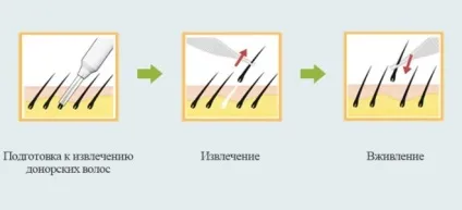 Пересадка волосся - операція з пересадки волосся і безопераційна процедура (операція) Пересадка волосся - операція з пересадки волосся і безопераційна процедура
