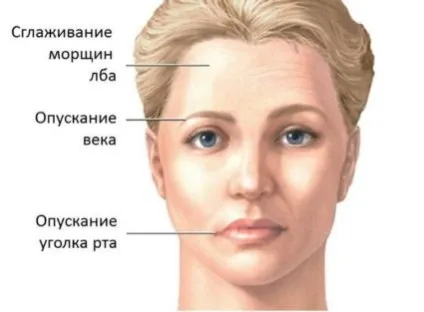 Парез окорухового нерва причини, симптоми, діагностика, лікування (окорухового) Парез окорухового нерва причини, симптоми, діагностика, лікування