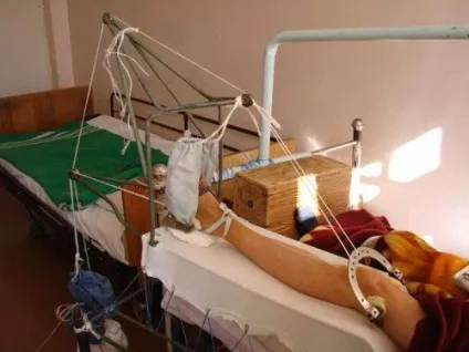 Перелом стегна в похилому віці лікування без операції терміни відновлення (стегна) Перелом стегна в похилому віці лікування без операції терміни відновлення
