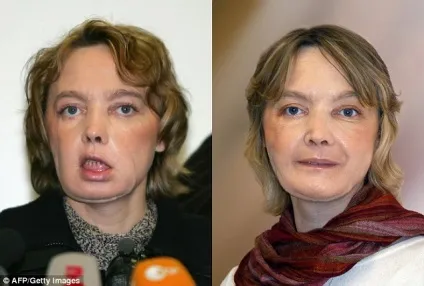 Перша жінка з пересадженим обличчям померла від раку, викликаного ліками проти відторгнення (жінка) Перша жінка з пересадженим обличчям померла від раку, викликаного ліками проти відторгнення