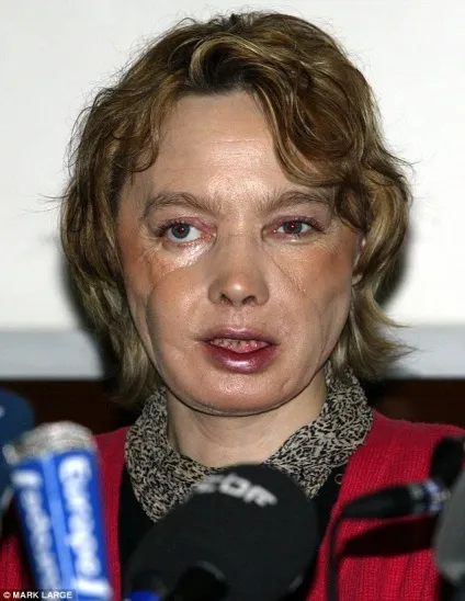 Перша жінка з пересадженим обличчям померла від раку, викликаного ліками проти відторгнення (жінка) Перша жінка з пересадженим обличчям померла від раку, викликаного ліками проти відторгнення
