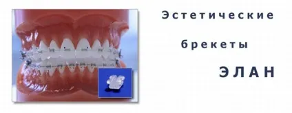 Пластикові (композитні) брекети elan, silkon, spirit, avalon, rave, vogue (sag) (композитний брекет що таке) Пластикові (композитні) брекети elan, silkon, spirit, avalon, rave, vogue (sag)