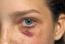 Чому синяк змінює колір і чому синці іноді з'являються не відразу (колір) Чому синяк змінює колір і чому синці іноді з'являються не відразу