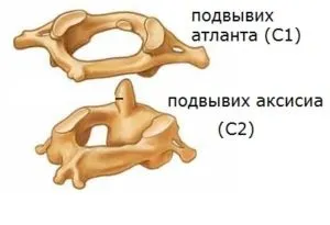 Вивих шийного хребця - симптоми, лікування, наслідки, ознаки перелому і підвивиху (симптоми) Вивих шийного хребця - симптоми, лікування, наслідки, ознаки перелому і підвивиху
