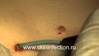 Опукла родимка причини появи